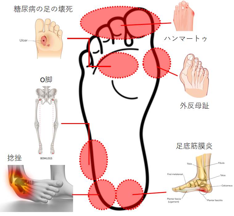 【Health Science Blog】Vol.17 「外反母趾になりやすい歩き方ってあるの？足にどのように体重かけるかで、人生のQOLが決まるといっても過言ではない！」